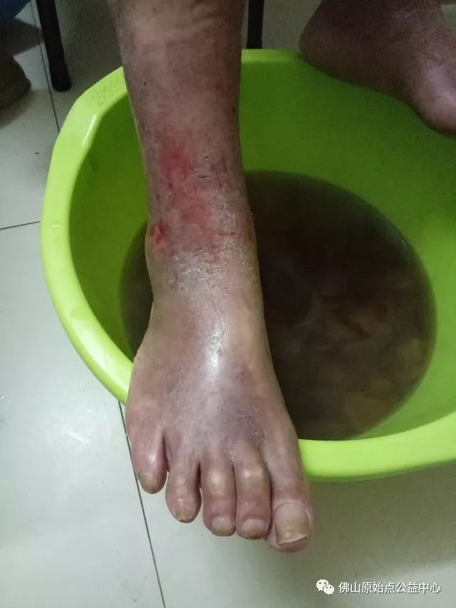 原始点调理全身肿胀溃烂：九个月，雨过天睛 - 皮肤 - 佛山市愿天下无痛健康管理服务有限公司