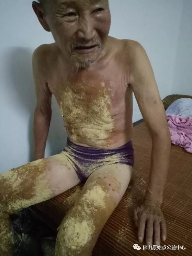 原始点调理全身肿胀溃烂：九个月，雨过天睛 - 皮肤 - 佛山市愿天下无痛健康管理服务有限公司