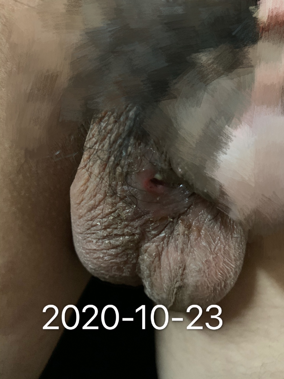 原始点调理男孩尿道下裂术后刀口破口案例 - 幼儿 儿童 - 佛山市愿天下无痛健康管理服务有限公司-原始点全球同学网