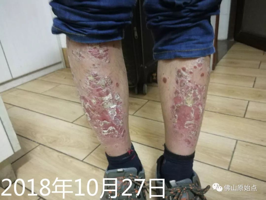 原始点调理牛皮癣案例 - 皮肤 - 佛山市愿天下无痛健康管理服务有限公司