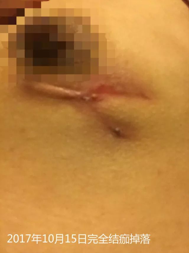 原始点调理乳房溃烂：一位德国媳妇飞越半球的原始点求医经历 - 乳腺增生  乳腺癌 - 佛山市愿天下无痛健康管理服务有限公司