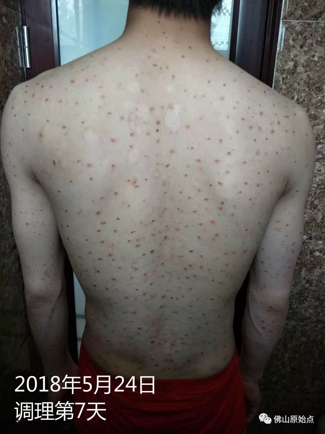 原始点调理严重牛皮癣及静脉曲张：84天完好如初 - 皮肤 - 佛山市愿天下无痛健康管理服务有限公司