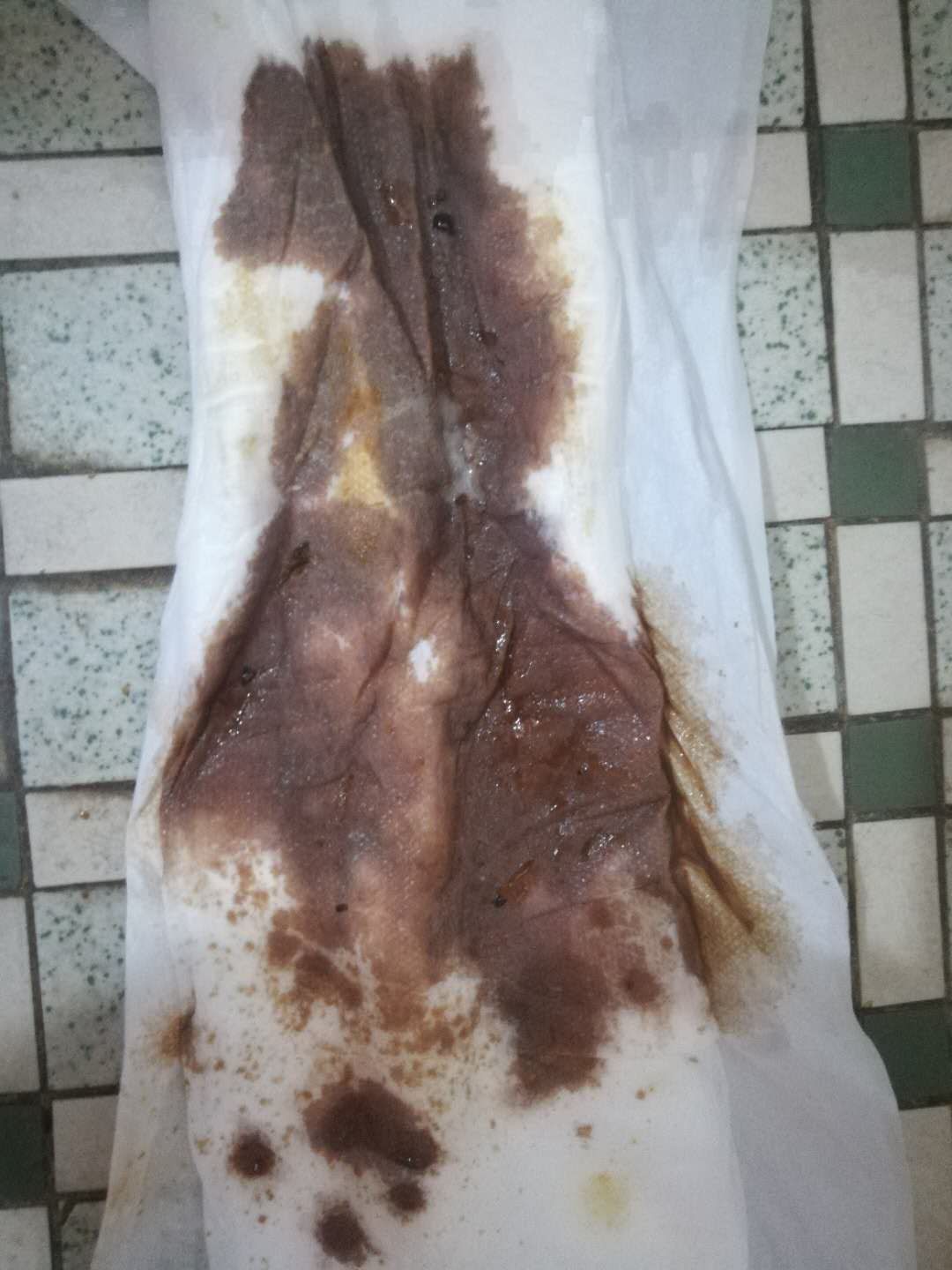 原始点调理卵巢囊肿案例 - 妇产   - 佛山市愿天下无痛健康管理服务有限公司