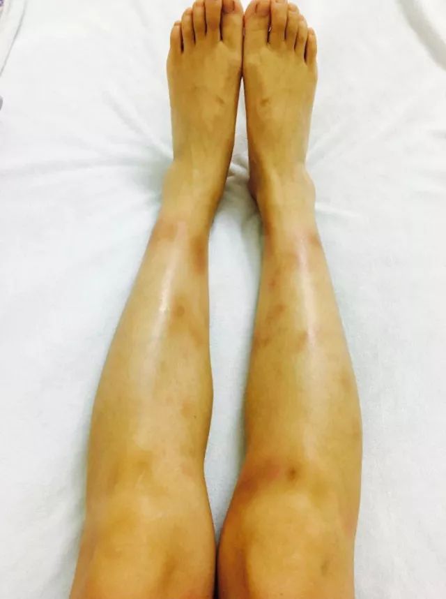 原始点调理乳房溃烂：一位德国媳妇飞越半球的原始点求医经历 - 乳腺增生  乳腺癌 - 佛山市愿天下无痛健康管理服务有限公司