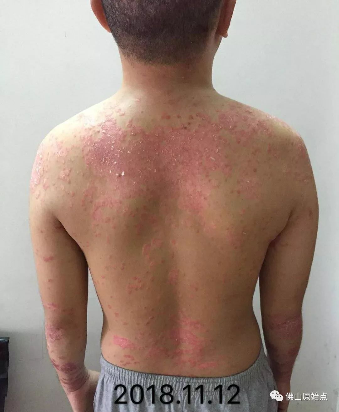 原始点调理牛皮癣案例 - 皮肤 - 佛山市愿天下无痛健康管理服务有限公司