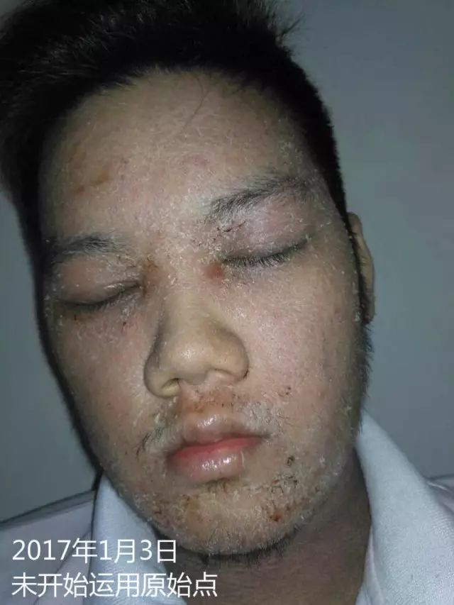 原始点21天调理23年严重湿疹案例 - 皮肤 - 佛山市愿天下无痛健康管理服务有限公司