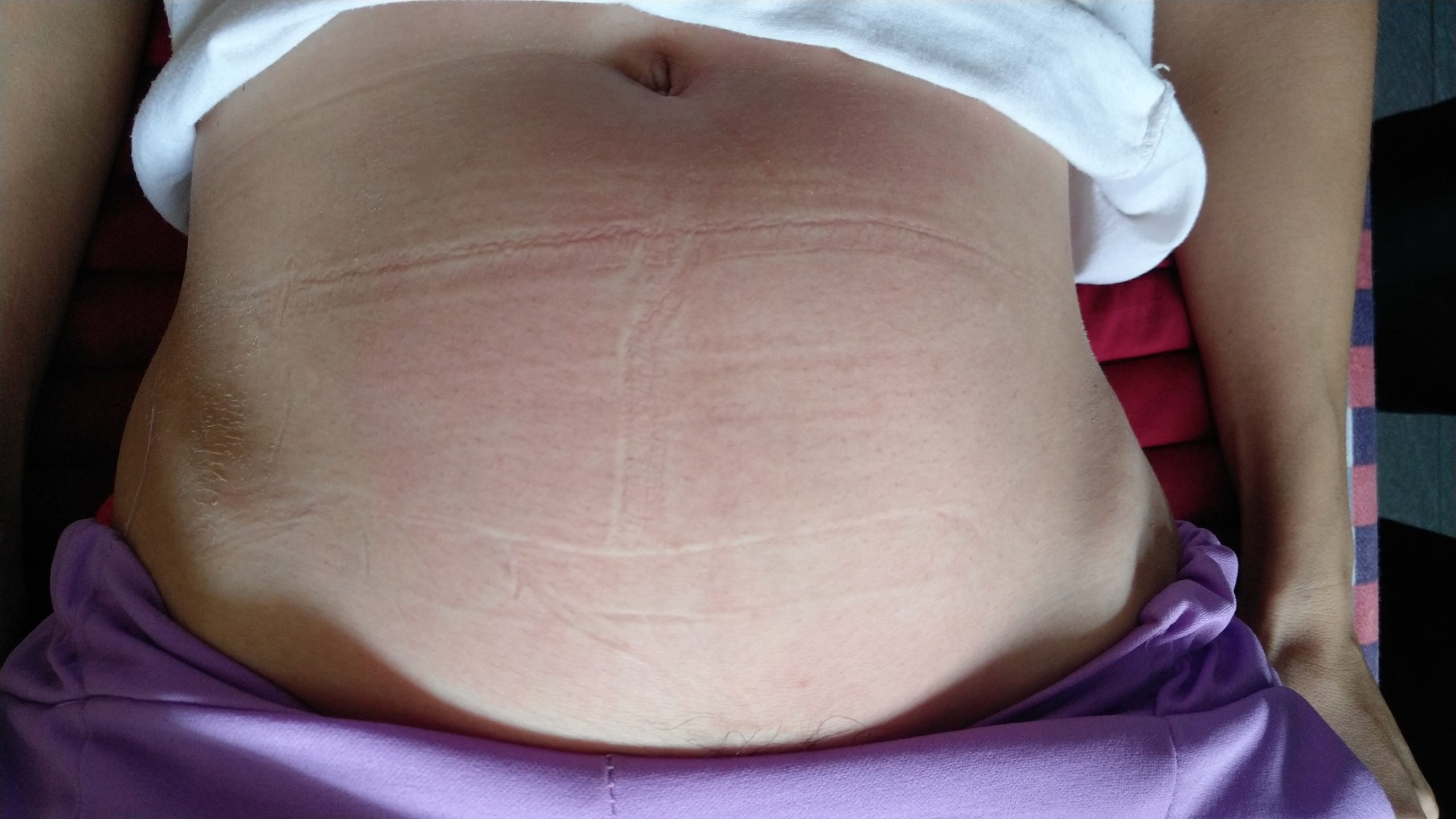 原始点调理卵巢囊肿案例 - 妇产   - 佛山市愿天下无痛健康管理服务有限公司