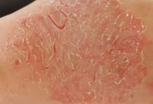 手背部湿疹案例-原始点全球同学网