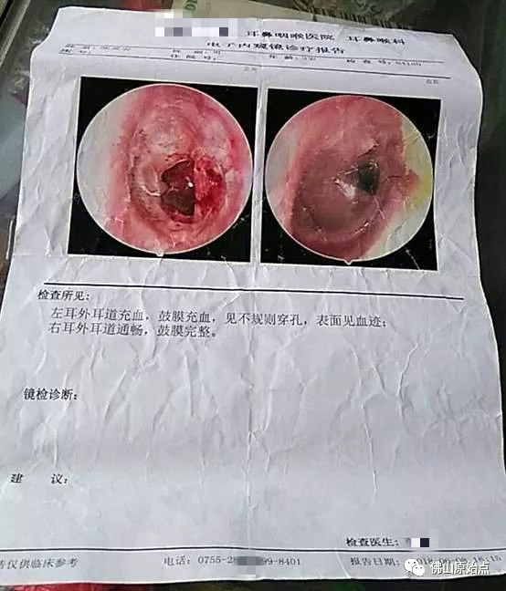 原始点调理耳膜穿孔与失聪案例 - 头颈  五官 - 佛山愿天下无痛