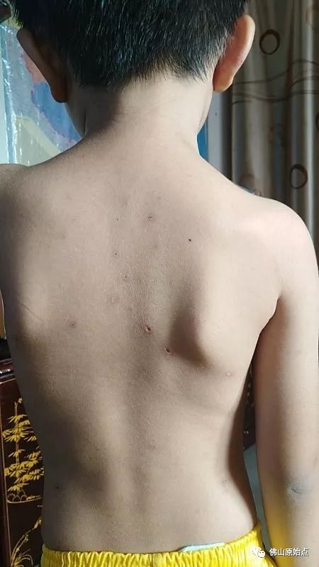 佛山愿天下无痛学员花开深圳：妈妈用原始点为七岁儿调理水痘案例 - 幼儿  儿童 - 佛山愿天下无痛