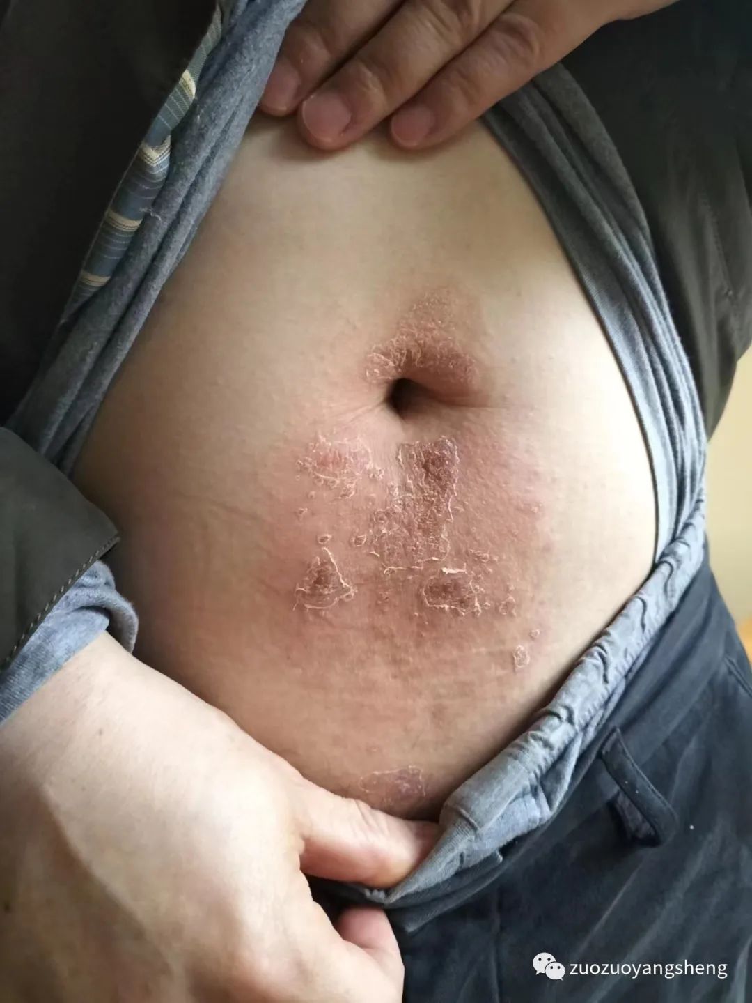 案例分享:原始点调理腹部奇痒无比的湿疹案例 案例分享:原始点调理腹部奇痒无比的湿疹案例