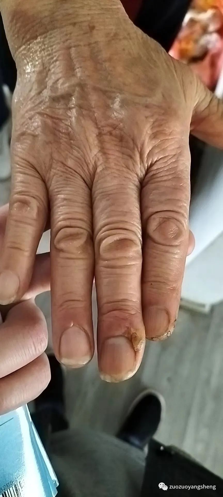 案例分享:原始点处理手指被夹伤血流不止的案例 案例分享:原始点处理手指被夹伤血流不止的案例