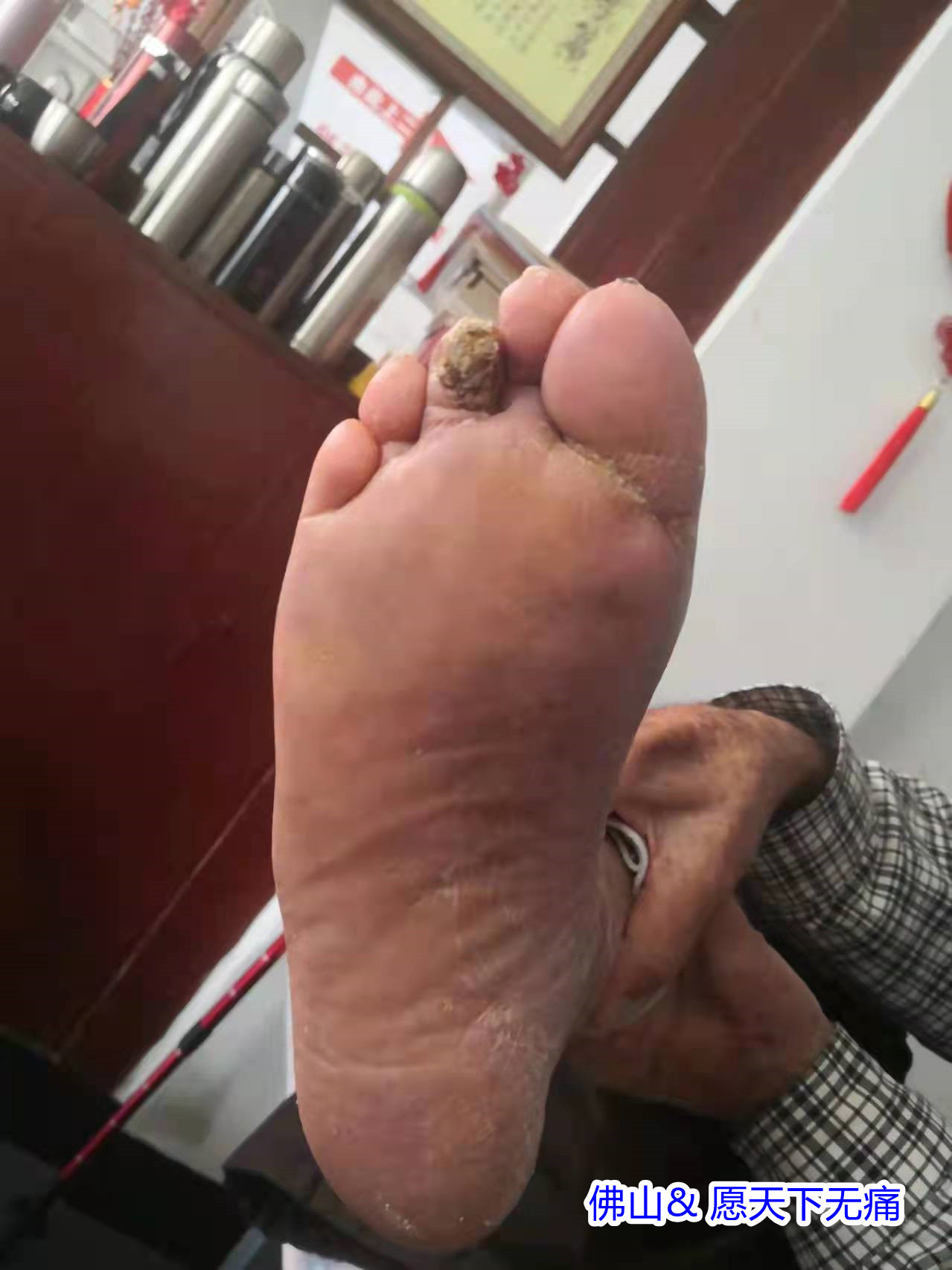 原始点调理脚烂案例(郑帝坚) - 四肢 - 佛山愿天下无痛