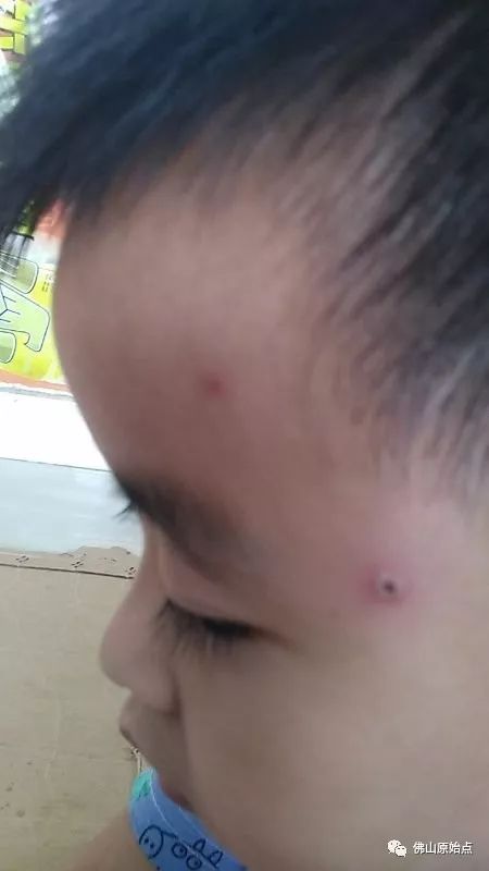 佛山愿天下无痛学员花开深圳：妈妈用原始点为七岁儿调理水痘案例 - 幼儿  儿童 - 佛山愿天下无痛