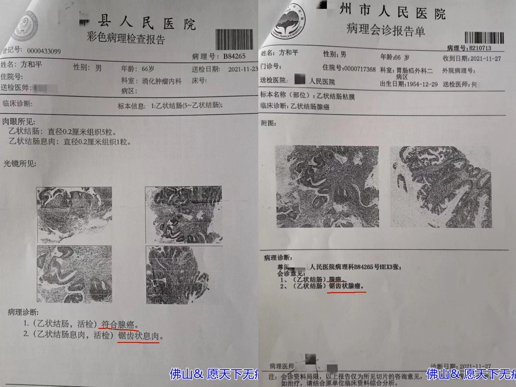 原始点调理结肠癌转肝癌 肚胀 便血案例 - 直肠癌  结肠癌 - 佛山愿天下无痛