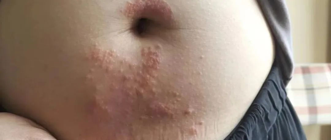 案例分享:原始点调理腹部奇痒无比的湿疹案例-原始点全球同学网
