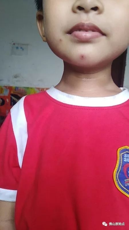 佛山愿天下无痛学员花开深圳：妈妈用原始点为七岁儿调理水痘案例 - 幼儿  儿童 - 佛山愿天下无痛
