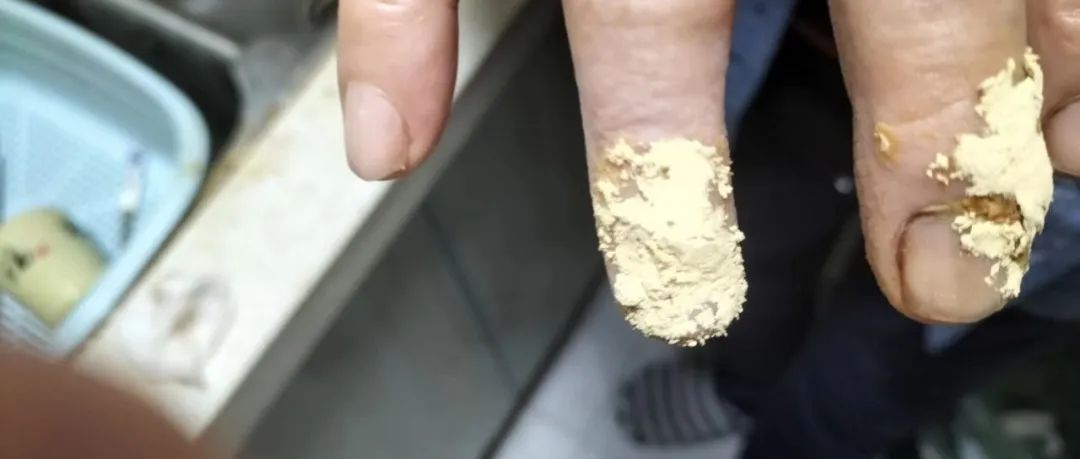 案例分享：原始点处理手指被夹伤血流不止的案例-原始点全球同学网