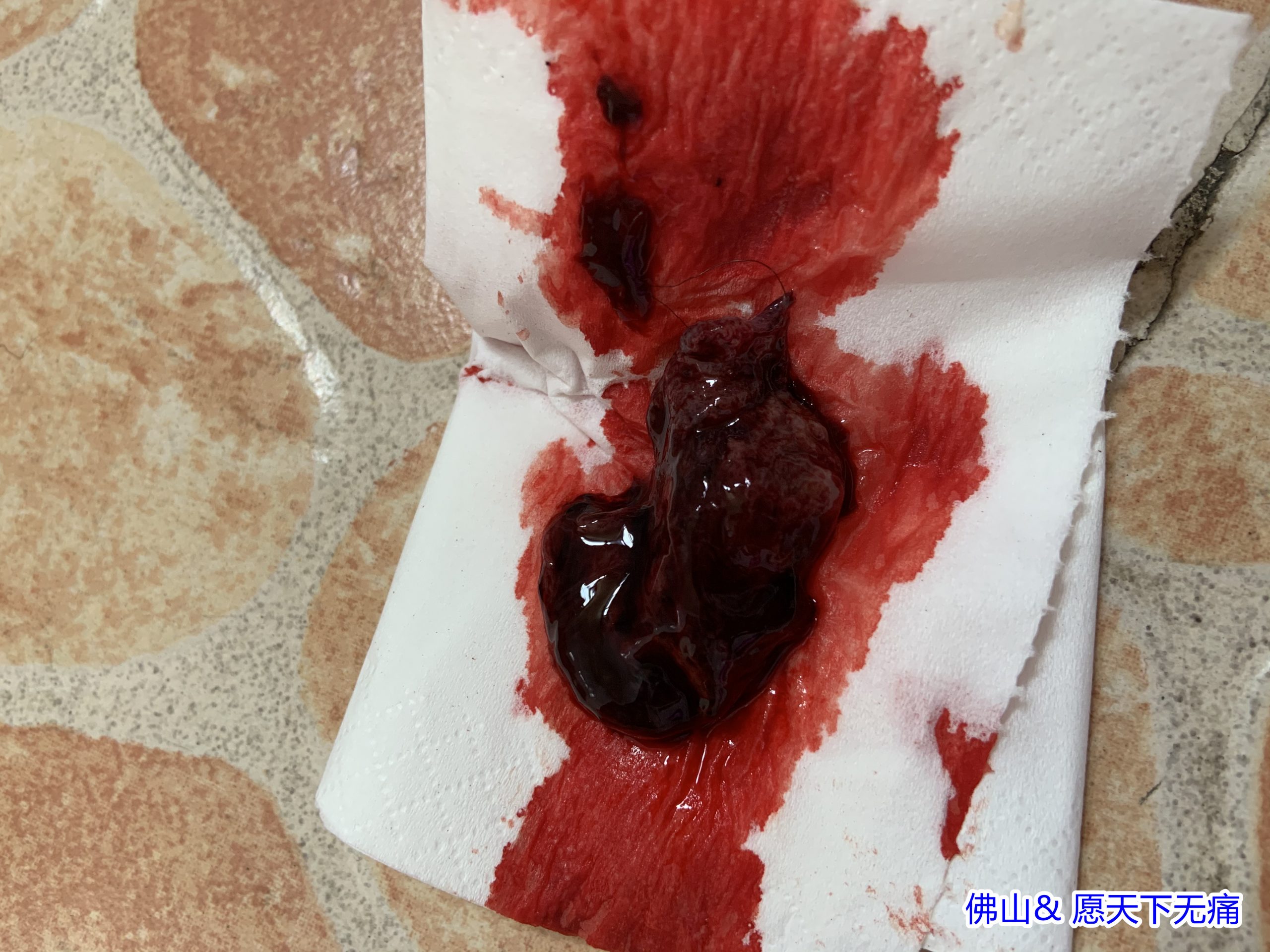 原始点调理胎死腹中 两天排出案例 - 妇产 - 佛山市愿天下无痛健康管理服务有限公司 原始点调理胎死腹中 两天排出案例 - 妇产 - 佛山市愿天下无痛健康管理服务有限公司