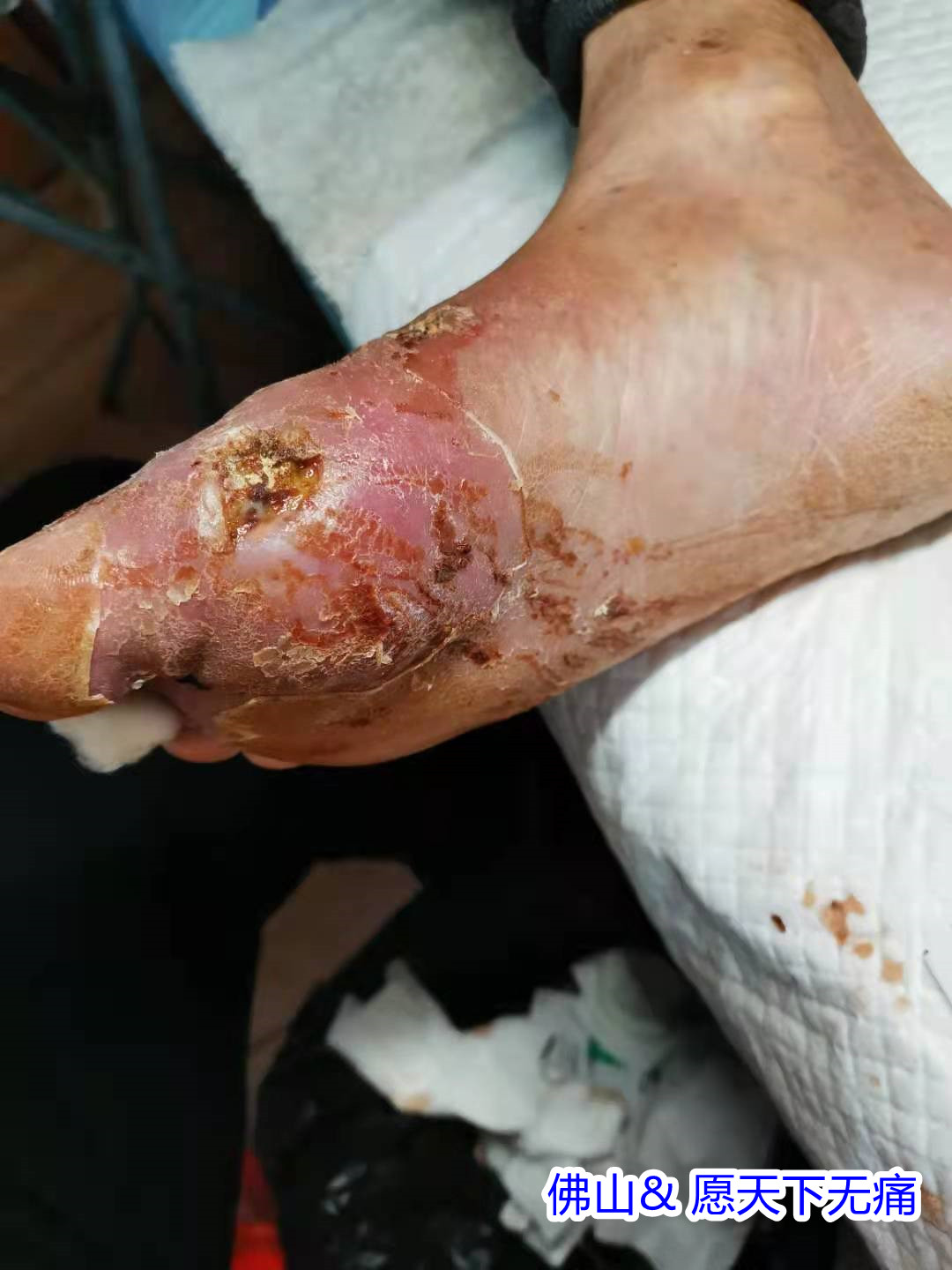 原始点调理脚烂案例(郑帝坚) - 四肢 - 佛山市愿天下无痛健康管理服务有限公司-原始点全球同学网