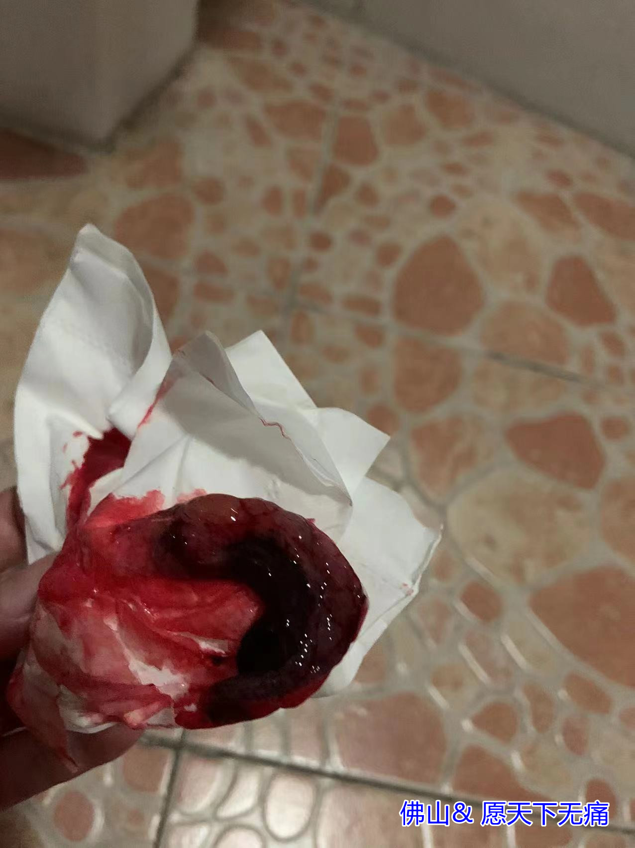 原始点调理胎死腹中 两天排出案例 - 妇产 - 佛山市愿天下无痛健康管理服务有限公司 原始点调理胎死腹中 两天排出案例 - 妇产 - 佛山市愿天下无痛健康管理服务有限公司