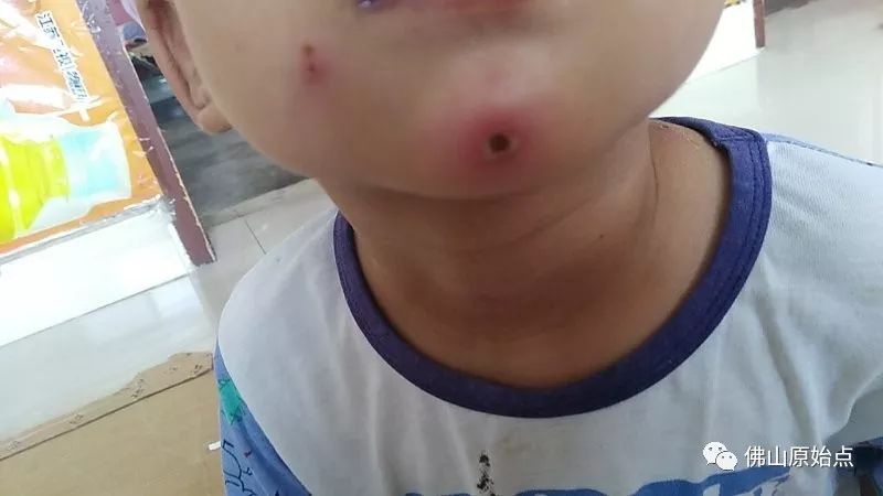 佛山愿天下无痛学员花开深圳：妈妈用原始点为七岁儿调理水痘案例 - 幼儿  儿童 - 佛山愿天下无痛