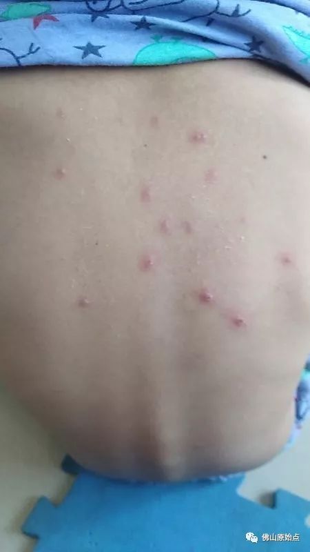 佛山愿天下无痛学员花开深圳：妈妈用原始点为七岁儿调理水痘案例 - 幼儿  儿童 - 佛山愿天下无痛