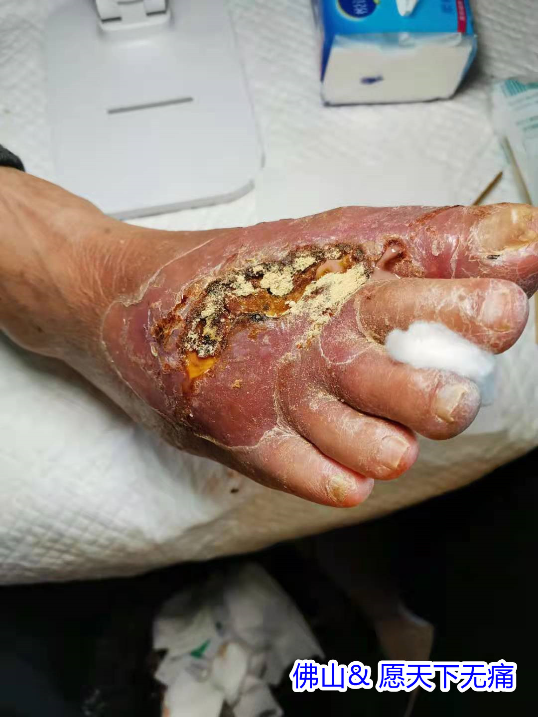 原始点调理脚烂案例(郑帝坚) - 四肢 - 佛山愿天下无痛