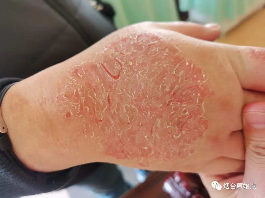 手背部湿疹案例