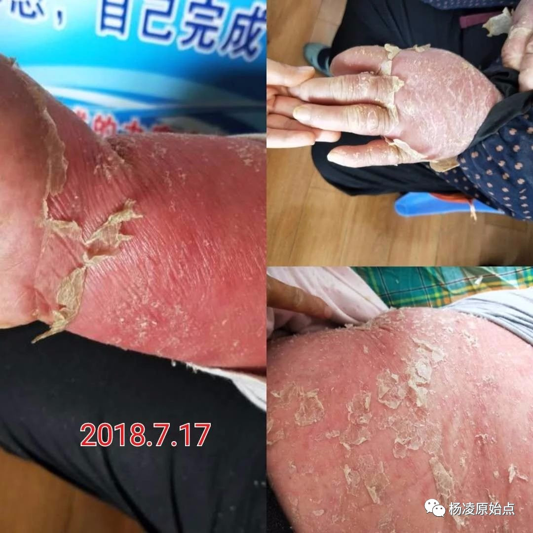 （杨凌）干癣症案例-原始点全球同学网