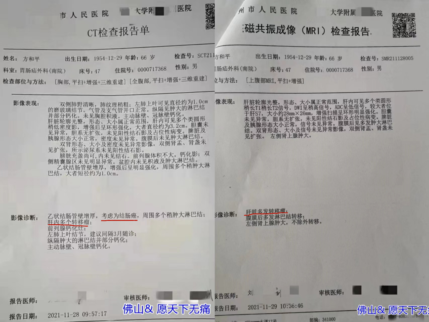 原始点调理结肠癌转肝癌 肚胀 便血案例 - 直肠癌  结肠癌 - 佛山愿天下无痛