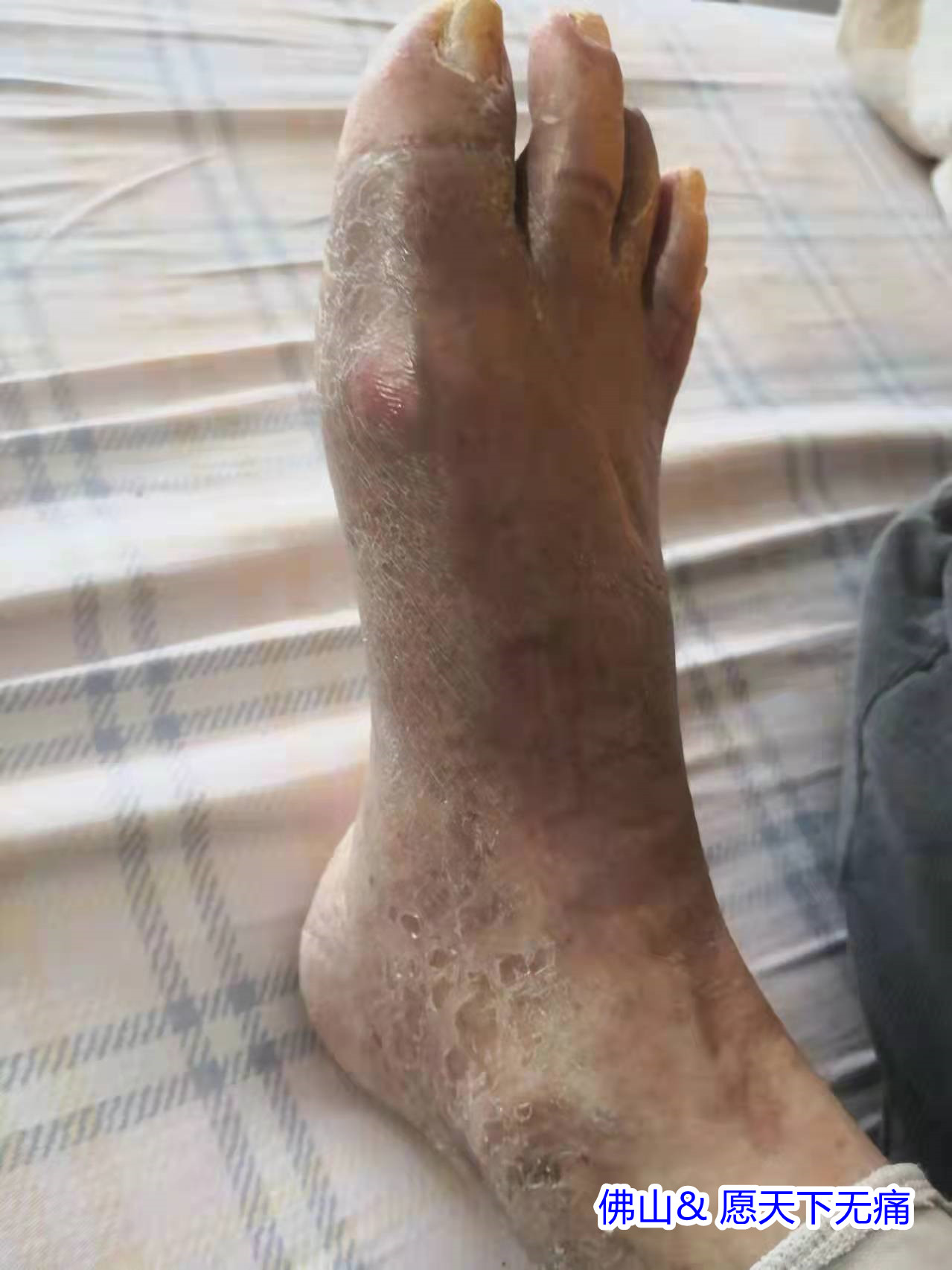 原始点调理脚烂案例(郑帝坚) - 四肢 - 佛山愿天下无痛