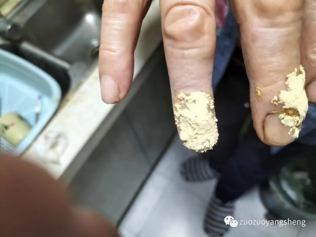 案例分享:原始点处理手指被夹伤血流不止的案例 案例分享:原始点处理手指被夹伤血流不止的案例