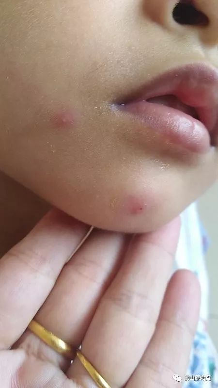 佛山愿天下无痛学员花开深圳：妈妈用原始点为七岁儿调理水痘案例 - 幼儿  儿童 - 佛山愿天下无痛