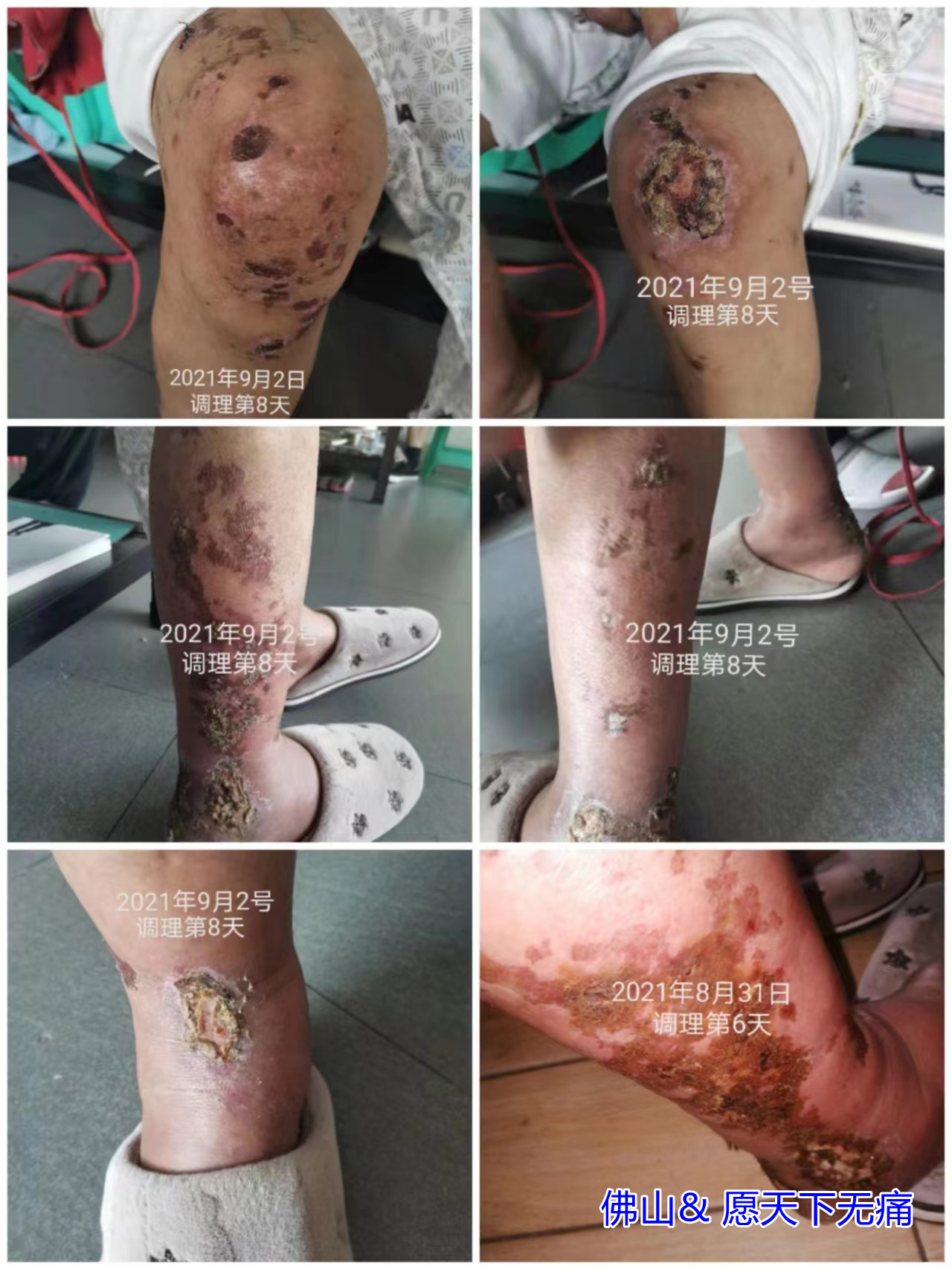 原始点调理骨髓瘤 臀部以下肿痛溃烂、鼻炎 胃炎 关节炎等案例 - 皮肤 - 佛山愿天下无痛 原始点调理骨髓瘤 臀部以下肿痛溃烂、鼻炎 胃炎 关节炎等案例 - 皮肤 - 佛山愿天下无痛