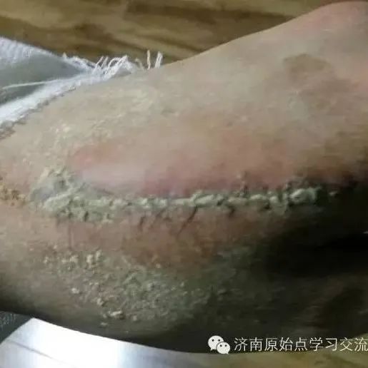 手部严重划伤/小孩烫伤案例-原始点全球同学网