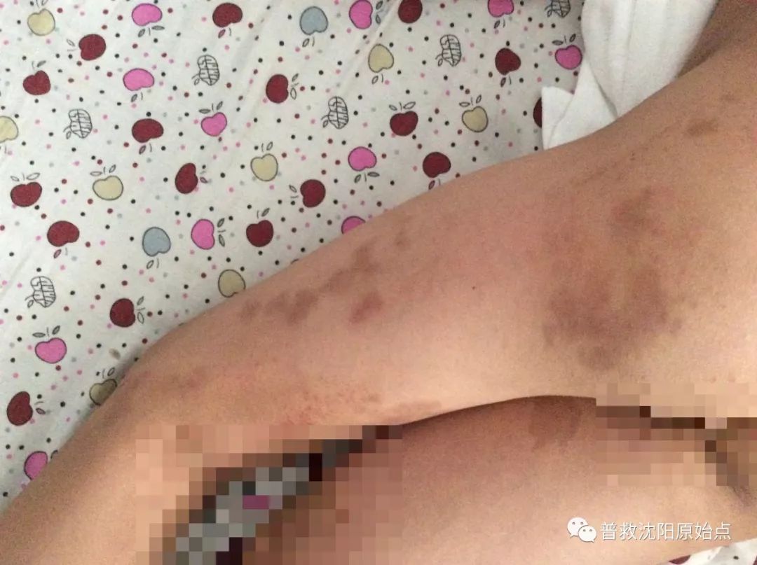 皮肤病案例（湿疹、水泡、破皮）