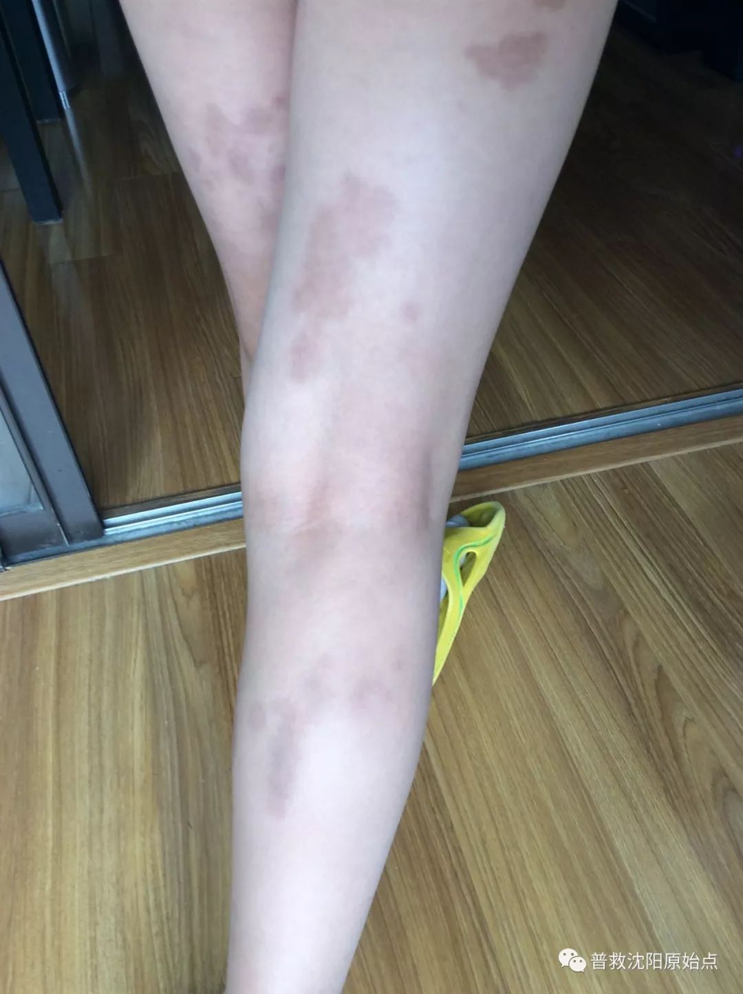 皮肤病案例（湿疹、水泡、破皮）