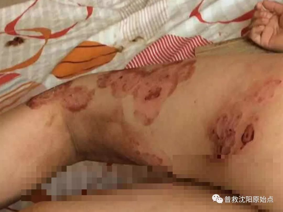 皮肤病案例（湿疹、水泡、破皮）