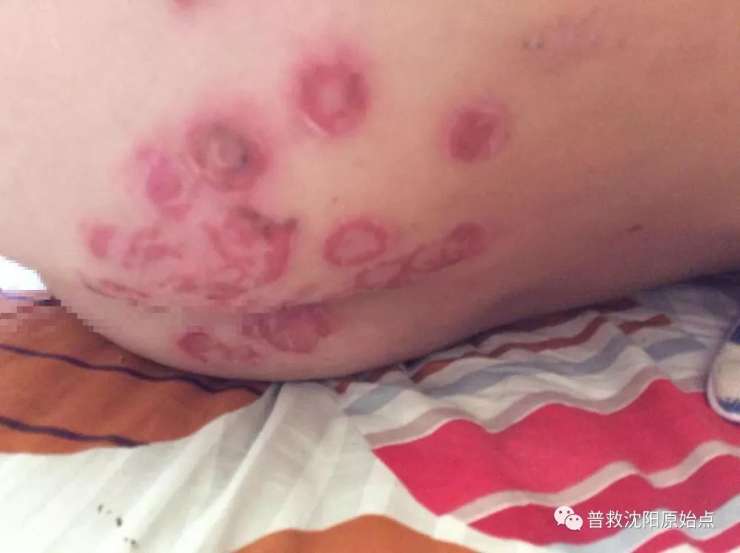 皮肤病案例（湿疹、水泡、破皮）