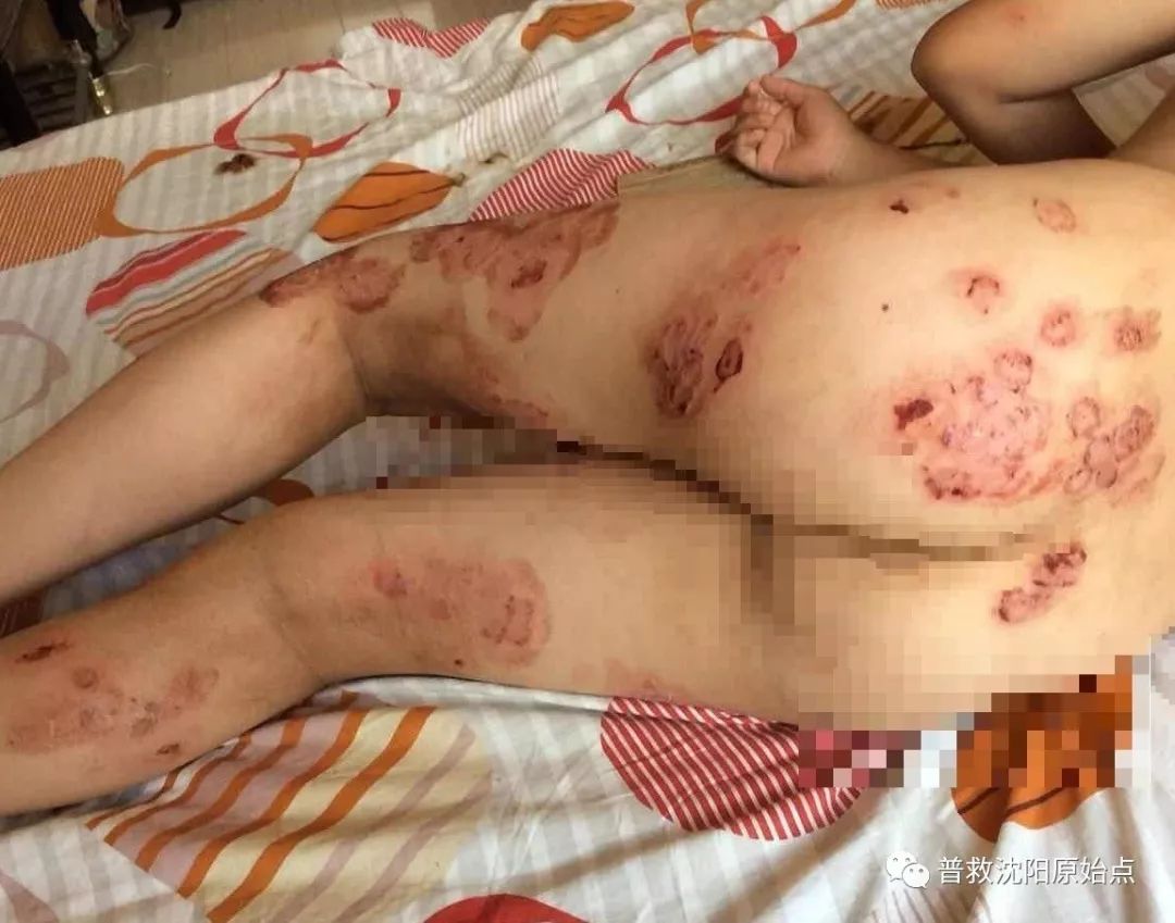 皮肤病案例（湿疹、水泡、破皮）