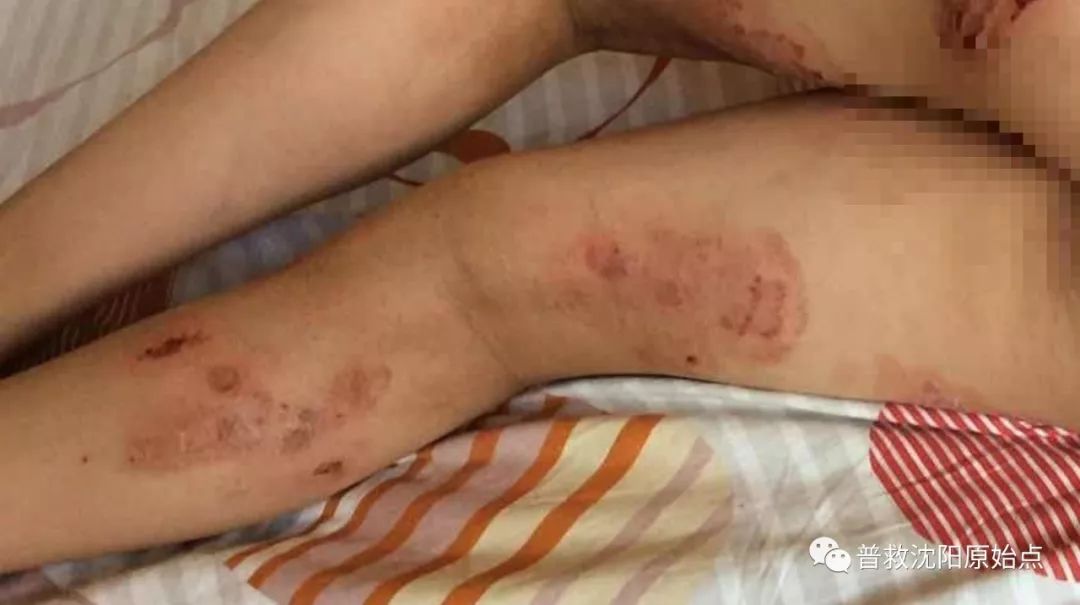 皮肤病案例（湿疹、水泡、破皮）