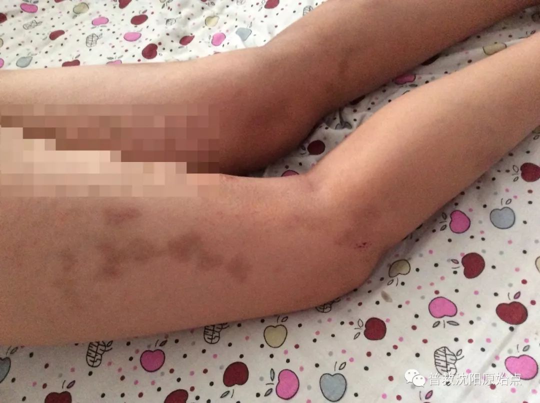 皮肤病案例（湿疹、水泡、破皮）