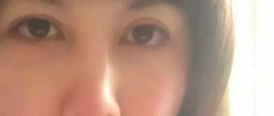 专家认为必须换骨头的半月板损伤恢复案例-原始点全球同学网
