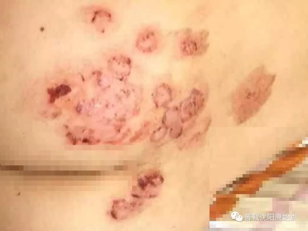 皮肤病案例（湿疹、水泡、破皮）
