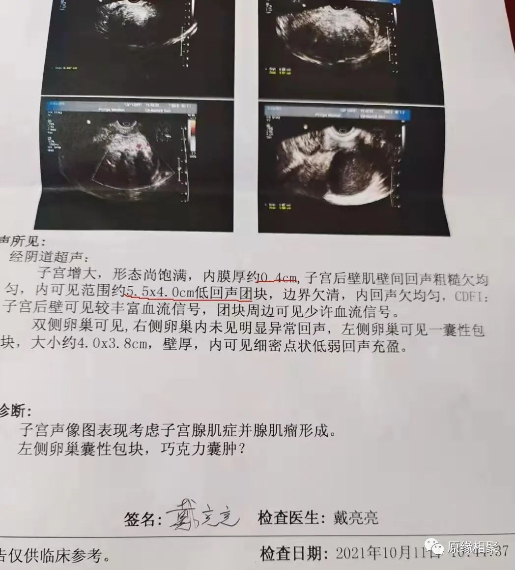 子宫腺肌症 子宫腺肌症