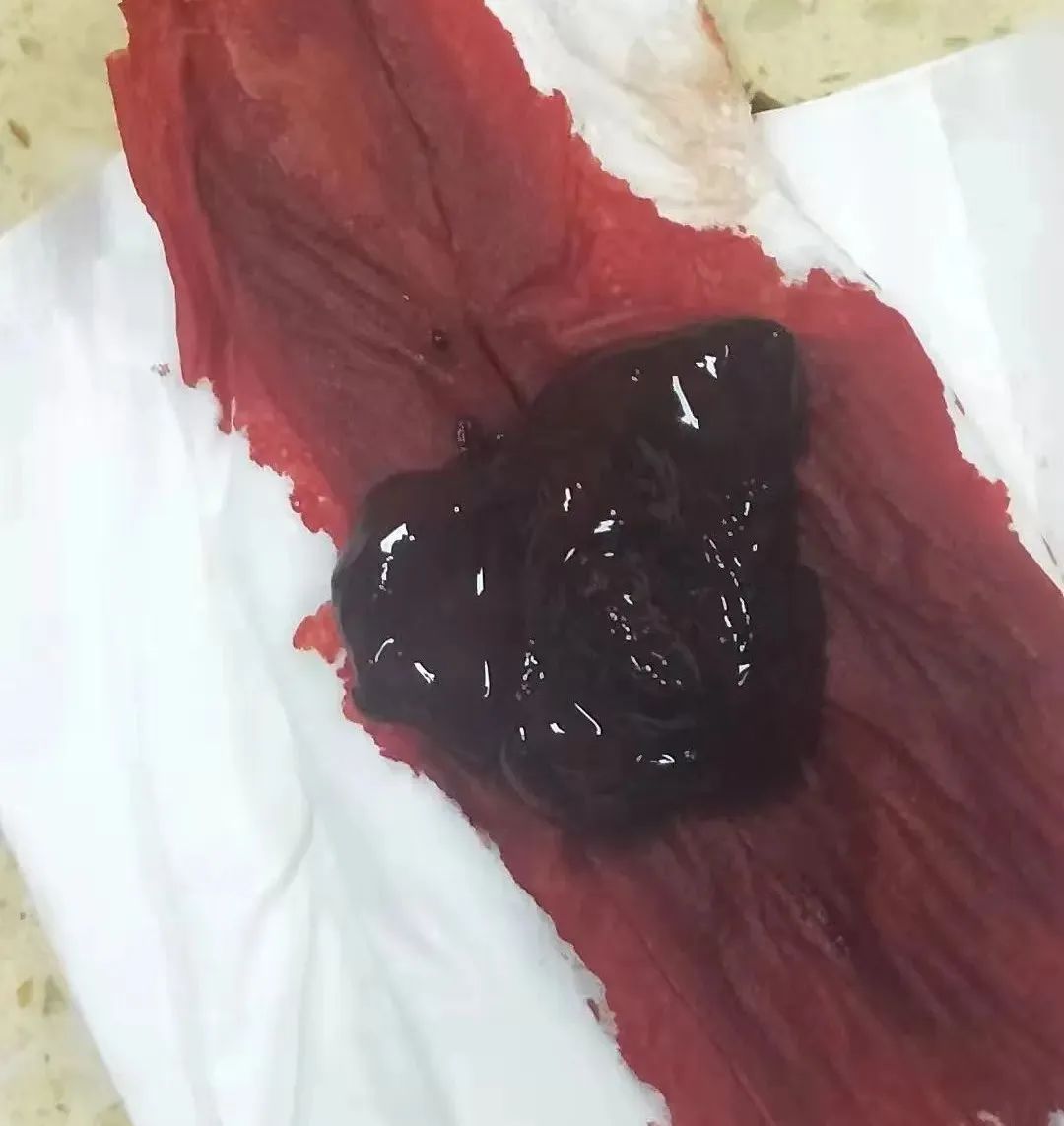 子宫腺肌症 子宫腺肌症