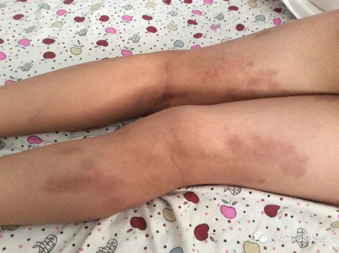 皮肤病案例（湿疹、水泡、破皮）