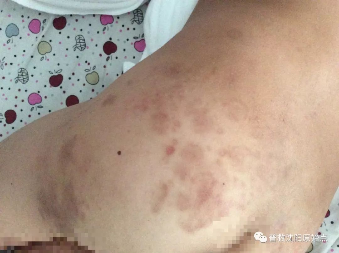 皮肤病案例（湿疹、水泡、破皮）