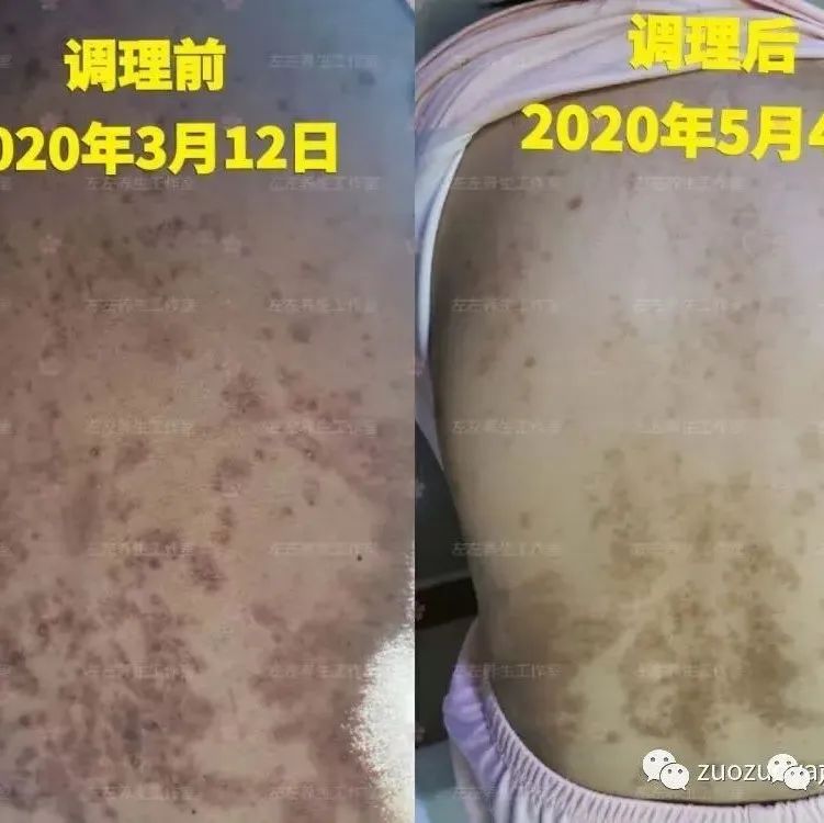 案例分享：产后高血压、全身奇痒无比调理案例-原始点全球同学网
